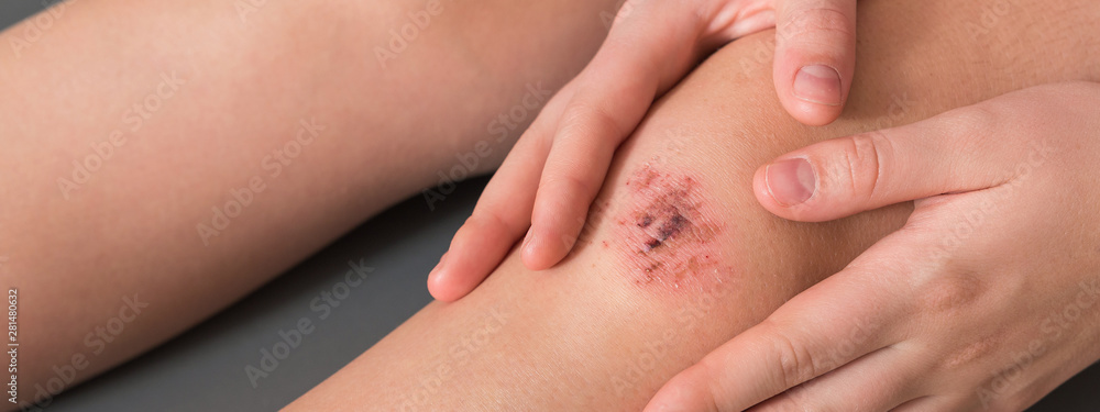 Injured leg wound knee with blood and doctor's hands in blue medical gloves treats a patient, treats a wound - obrazy, fototapety, plakaty 