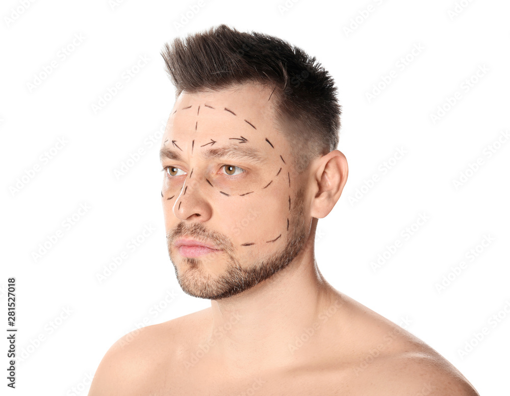 Man with marks on face for cosmetic surgery operation against white background Man with marks on face for cosmetic surgery operation against white background