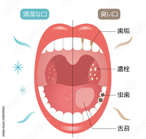 清潔な口　臭い口　口臭ケア　ビフォア　アフター