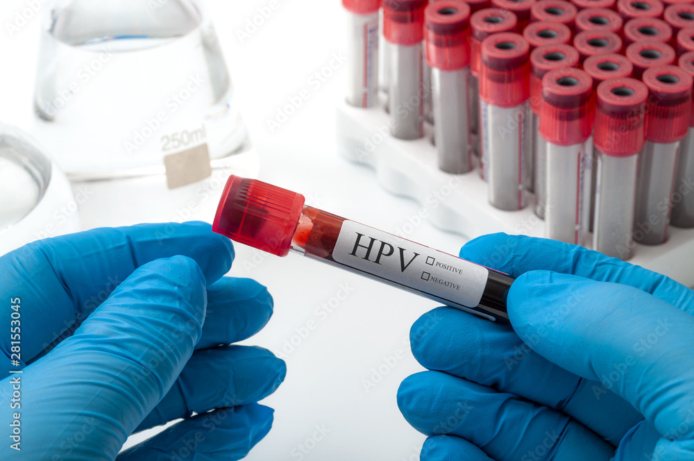 HPV, STD or sexually transmuted disease, medical research and clinical trial concept theme with blood sample in a test tube held by a phlebotomy doctor or nurse wearing protective latex gloves HPV, STD or sexually transmuted disease, medical research and clinical trial concept theme with blood sample in a test tube held by a phlebotomy doctor or nurse wearing protective latex gloves