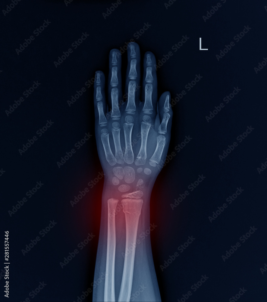 Left Wrist X-ray fracture raduis on red mark. Left Wrist X-ray fracture raduis on red mark.