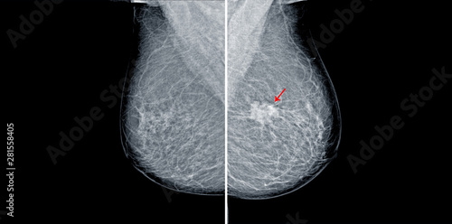 Mammogram radio imaging for breast cancer diagnosis