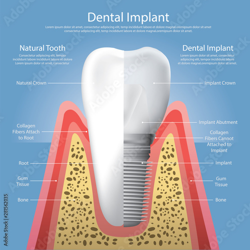 Human teeth and Dental implant Vector Illustration