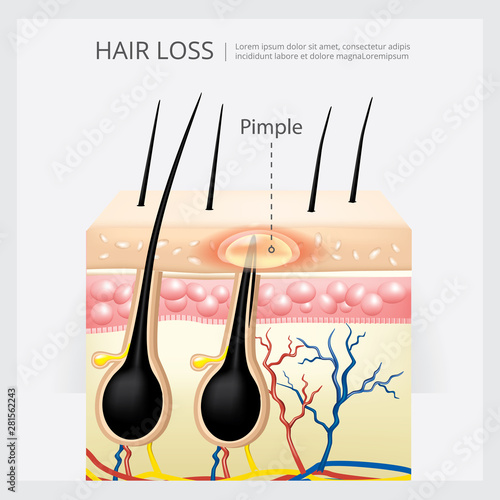 Hair Loss Structure Vector Illustration