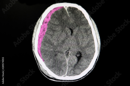 CT brain scan with acute subdural hematoma photo