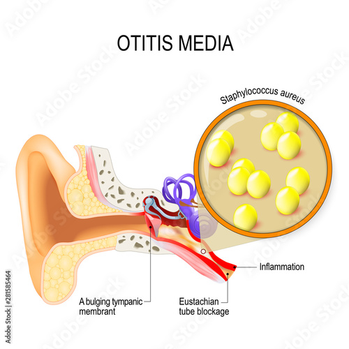 Otitis media and Staphylococcus aureus