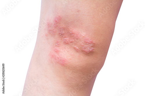 Close-up eczema atopic dermatitis symptom with infected skin on child leg  kid knee with copy space. Wound from insect bite or fungus or bacteria or virus.