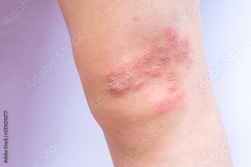 Close-up eczema atopic dermatitis symptom with infected skin on child leg, kid knee with copy space. Wound from insect bite or fungus or bacteria or virus.