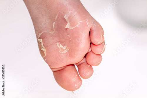 After the red rash and the strawberry tongue caused by scarlet fever the affected skin often peels - Here Skin of foot peeling