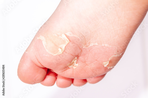 After the red rash and the strawberry tongue caused by scarlet fever the affected skin often peels - Here Skin of foot peeling