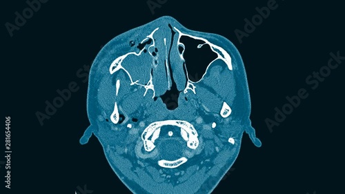 Computed tomography (CT scan ) of Orbit and brain
