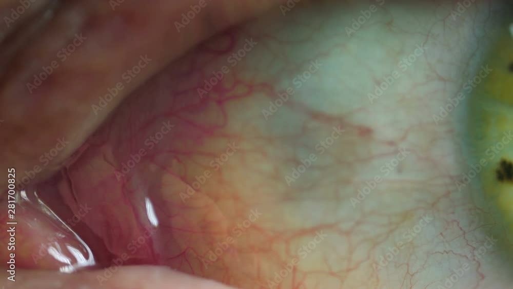Lacrimal caruncle and tear duct in human eye macro close up vídeo de ...