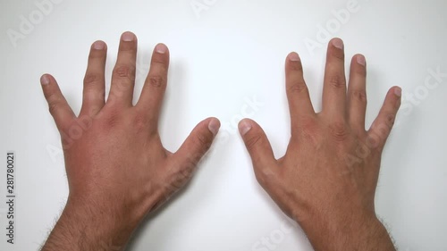 Comparison of two male hands stung by bee or wasp. Hand swelling, inflammation, redness are signs of infection. Insect bite on left hand on white background