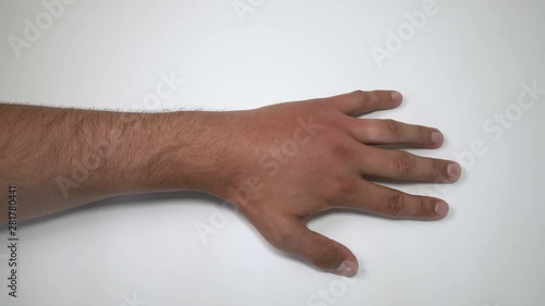 Male hand stung by bee or wasp. Hand swelling, inflammation, redness are signs of infection. Insect bite on left hand