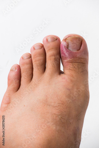 Εκτύπωση καμβά Close up of ingrown toenail is Inflamed fingernails