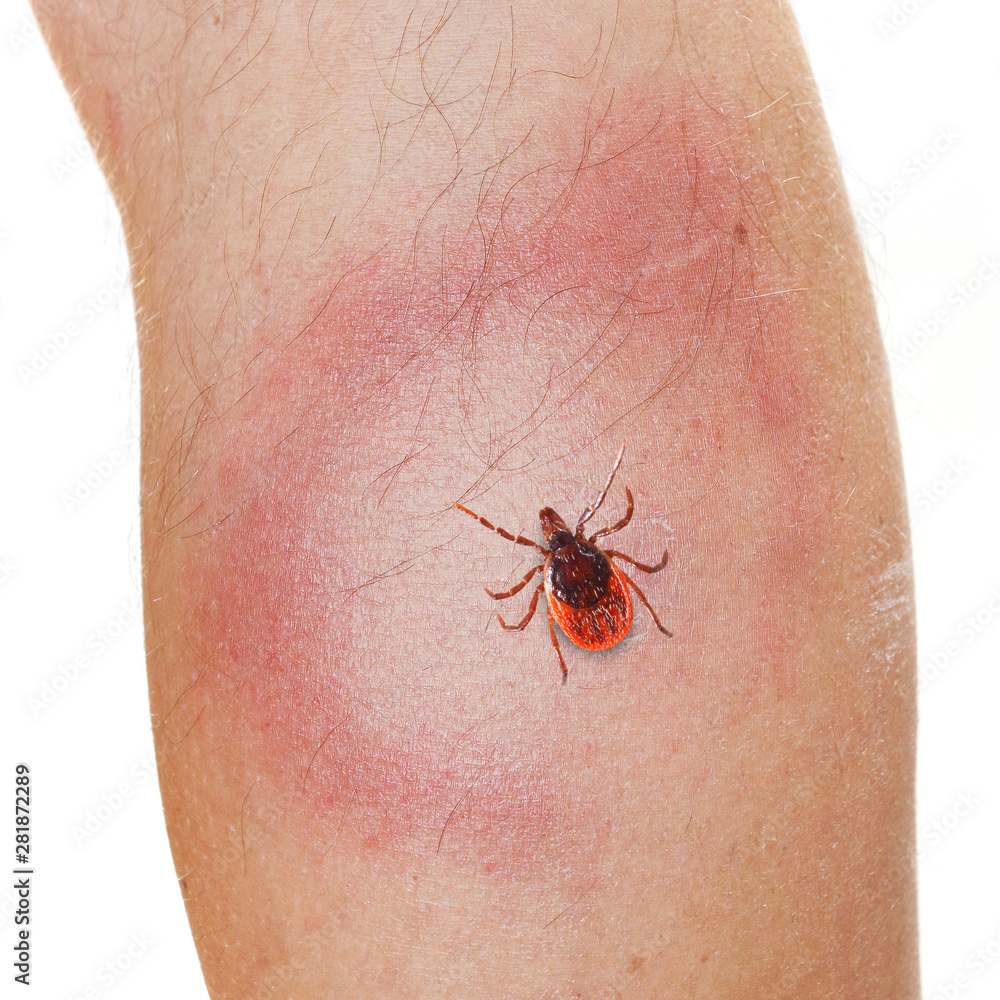 Foto Stock An Erythema Migrans rash often seen in the early stage of