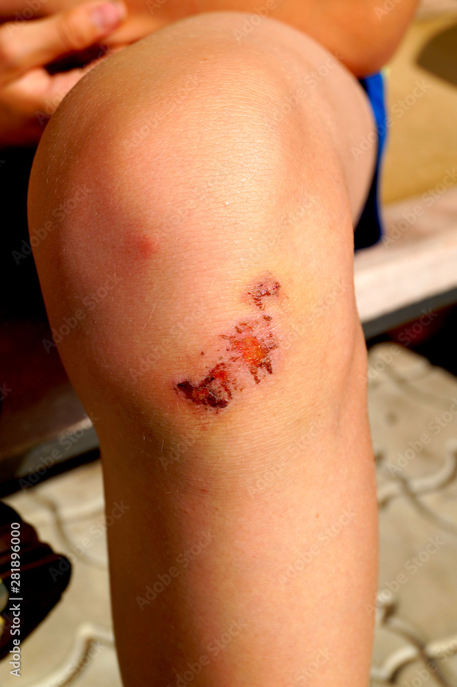 Dried blood on the scratch on the knee after falling. Dried blood on the scratch on the knee after falling.