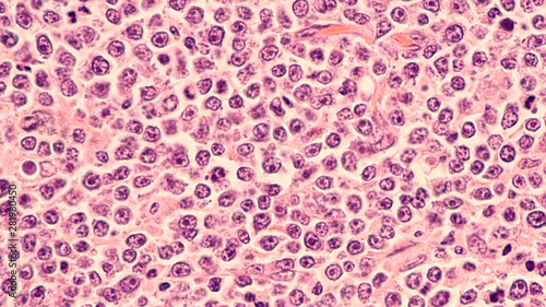 Tableau sur toile Lymphoma awareness: photomicrograph of a diffuse large B-cell lymphoma (DLBCL) a type of non-Hodgkin lymphoma
