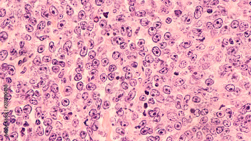 Photos Lymphoma awareness: photomicrograph of a diffuse large B-cell lymphoma (DLBCL) a type of non-Hodgkin lymphoma