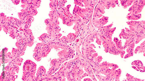Benign breast biopsy: Microscopic image of fibrocystic change (disease), stained with hematoxylin and eosin. Apocrine metaplasia with no cytologic atypia or malignancy is seen. photo