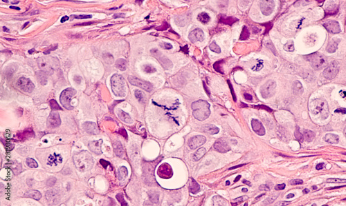 Photomicrograph of a breast cancer (grade 3 invasive ductal carcinoma) with frequent mitoses (mitotic figures), including a large central atypical mitosis.