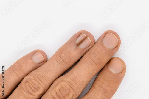 Obraz na płótnie Finger nail with melanonychia