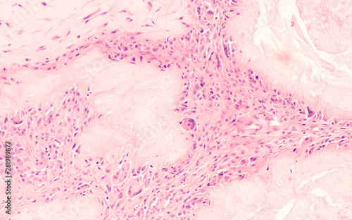 Microscopic image (photomicrograph) of a surgical specimen showing a gouty tophus, resulting from an accumulation of uric acid crystals, from a gout patient with high blood levels of  uric acid.