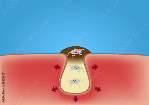 acne and bacteria virus vector