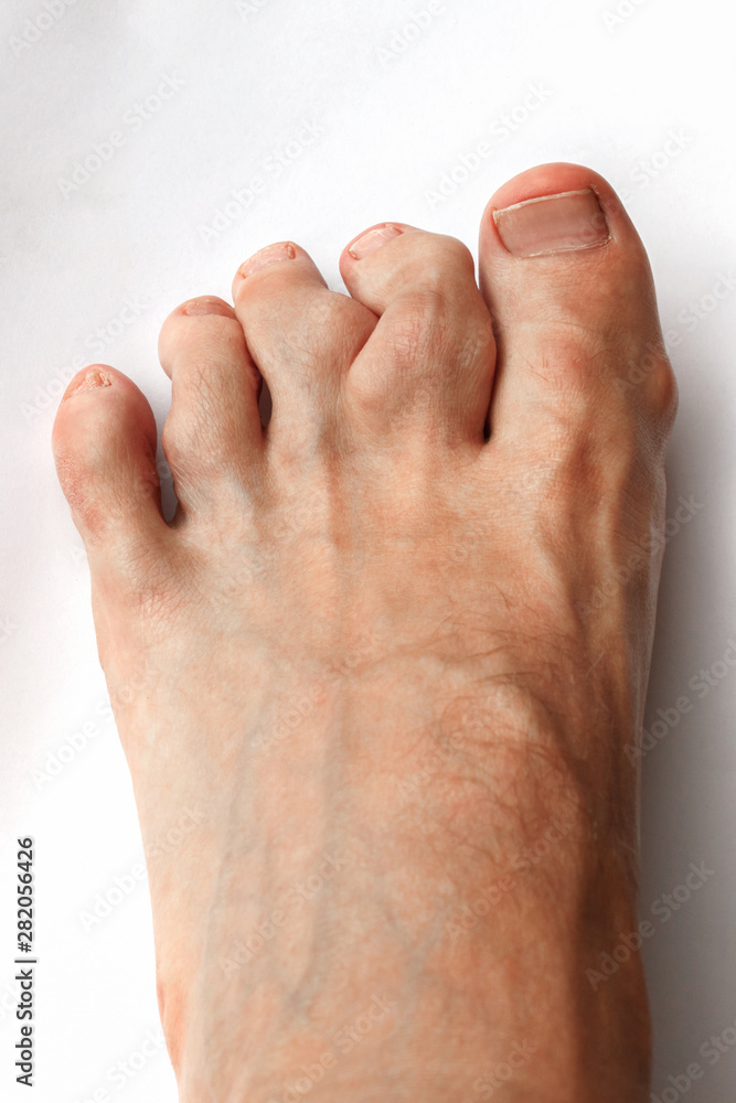 Recurrent attack of acute inflammatory arthritis (a red, tender, hot