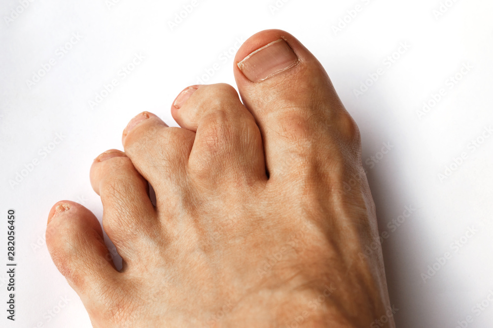 close-up of deformation of the toes caused by Rheumatoid polyarthritis with swelling of the foot of a young man. valgus deformity of the toes with pathologic enchondromas - obrazy, fototapety, plakaty 