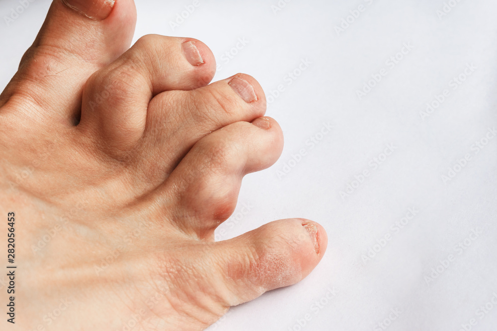 deformed toes after multiple fractures. swelling of the joints of the toes. Painful gout inflammation on toe joints, selective focus. gouty toes. toes affected by Gout . deformed toes after multiple fractures. swelling of the joints of the toes. Painful gout inflammation on toe joints, selective focus. gouty toes. toes affected by Gout .