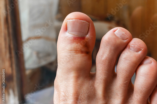 broken big toe after bounce. big toe bruise and inflamed gout. Painful gout inflammation on toe joints, selective focus