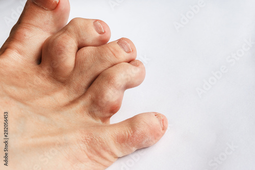 Foto deformed toes after multiple fractures