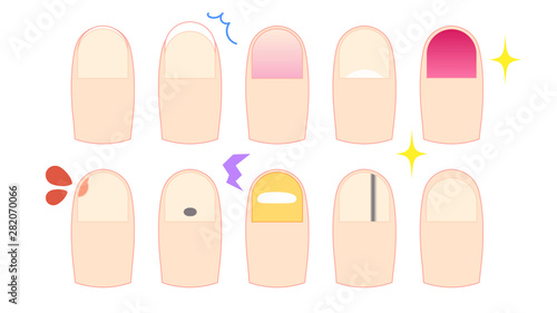 いろいろな状態の爪