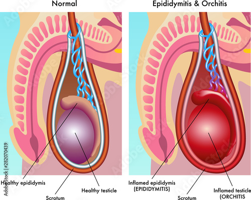 A medical illustration of two inflammations of the testicle called epididymitis and orchitis.