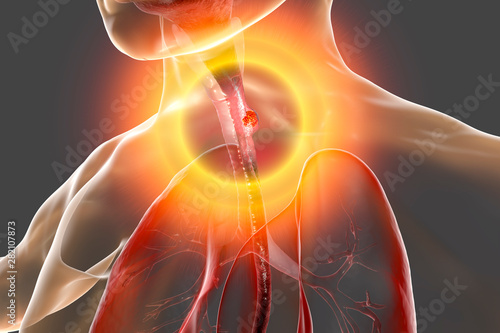 Tableau sur toile Esophageal cancer, illustration