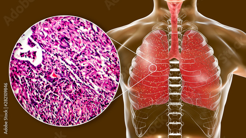 Miliary tuberculosis, illustration and light micrograph photo