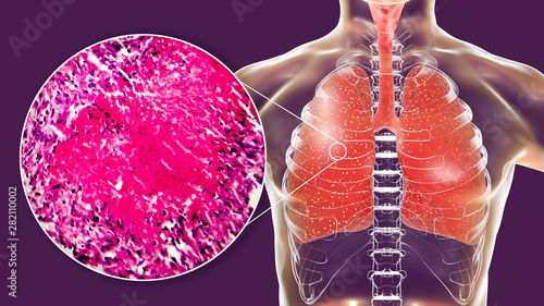 Φωτογραφία Miliary tuberculosis, illustration and light micrograph