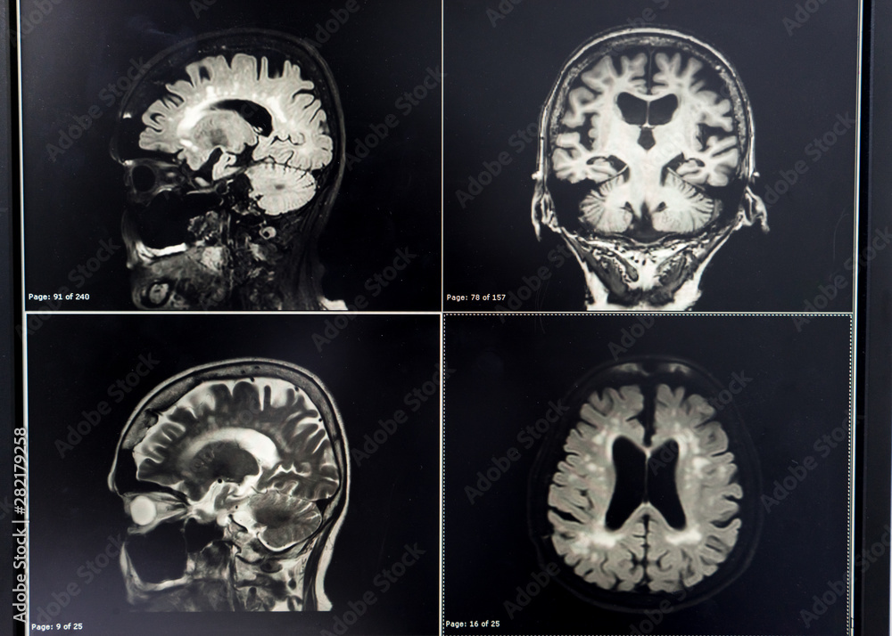 brain MRI for education Dementia Mix type stroke VaD Stock Photo | Adobe  Stock