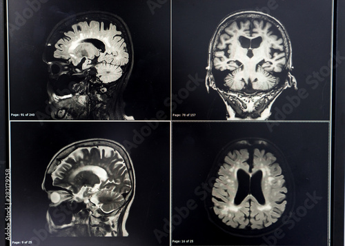 brain MRI for education Dementia Mix type stroke VaD