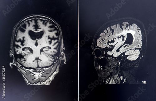 brain MRI for education Dementia Mix type stroke VaD