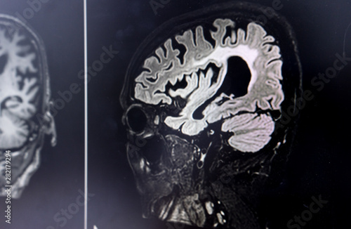 Canvas Print brain MRI for education Dementia Mix type stroke VaD