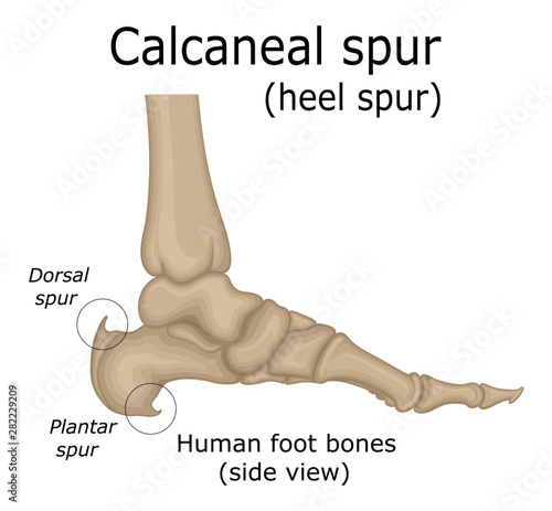 Illustration of Calcaneal spur