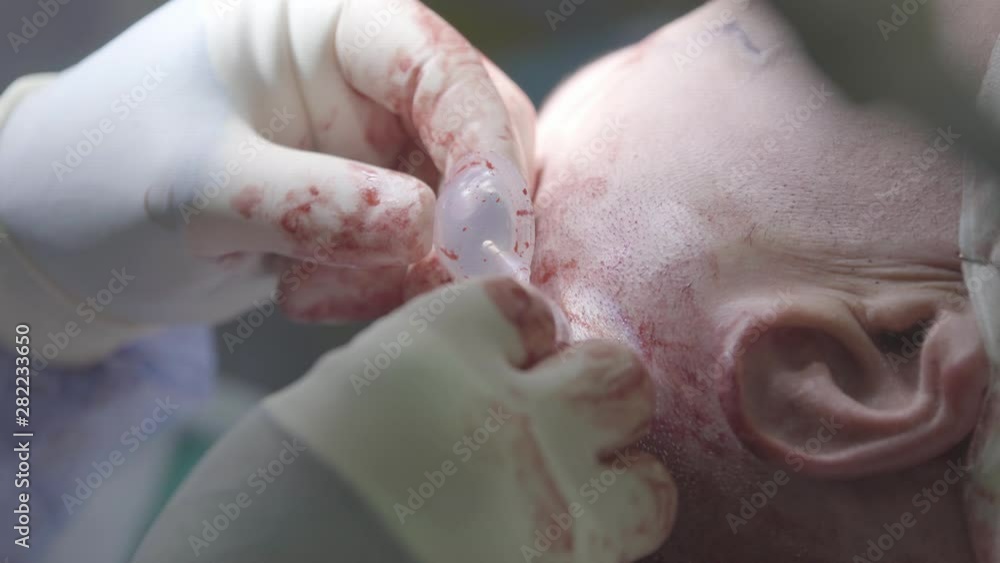 Surgeon installs the expander under the head skin above the ear during the plastic surgery (macro, 4K, 25fps) Surgeon installs the expander under the head skin above the ear during the plastic surgery (macro, 4K, 25fps)