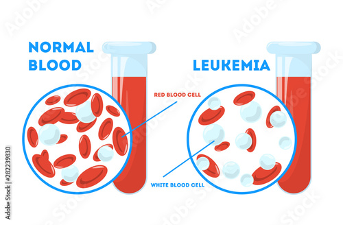 Comparison between normal blood and leukemia. Dangerous