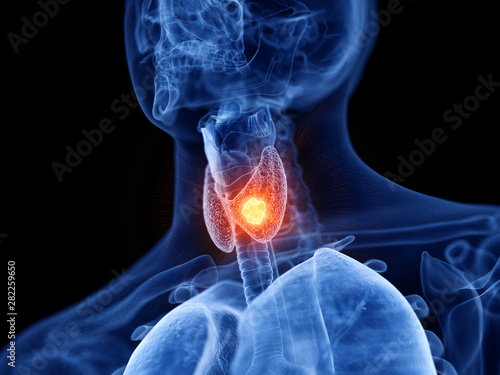 3d rendered medically accurate illustration of thyroid cancer