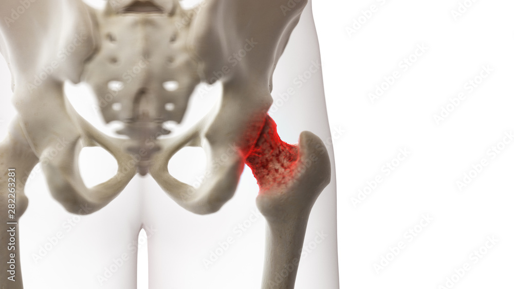 3d rendered medically accurate illustration of an arthritic hip joint - obrazy, fototapety, plakaty 