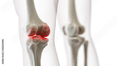 3d rendered medically accurate illustration of an arthritic knee joint photo