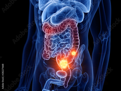 3d rendered medically accurate illustration of colon cancer