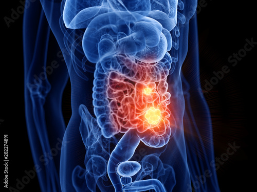 3d rendered medically accurate illustration of small intestine cancer © Sebastian Kaulitzki